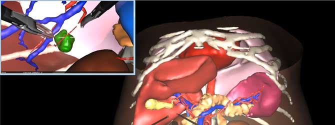 https://ircad-content.b-cdn.net/Liver-planning2.jpg